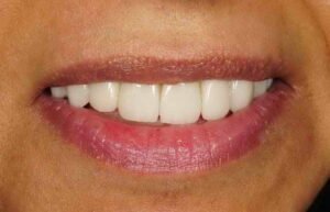 ابتسامة هوليود 01