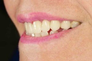 ابتسامة هوليود 03