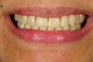 ابتسامة هوليود 06