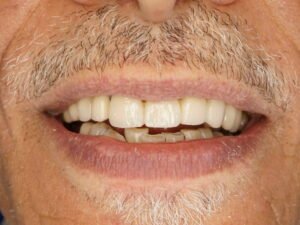 تركيبات الزيركون