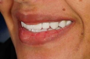 زراعة أسنان 03