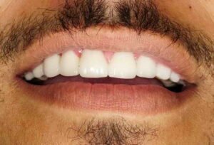 زراعة أسنان 04