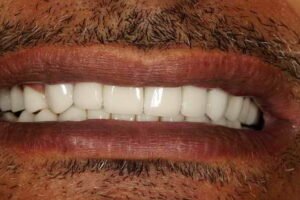 زراعة أسنان 05