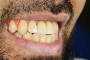 زراعة الأسنان 01