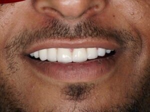 زراعة الأسنان 06