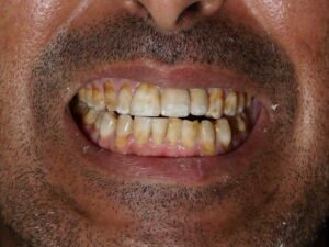 زراعة الأسنان 07